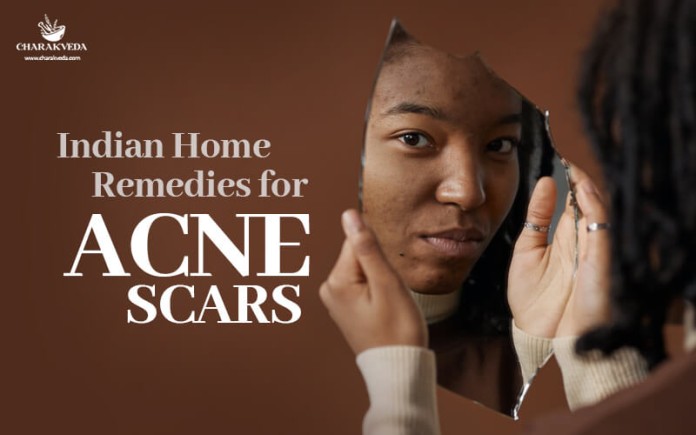 ACNE SCARS