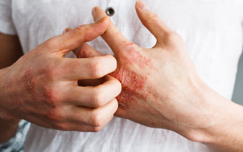 Skin Related Diseases